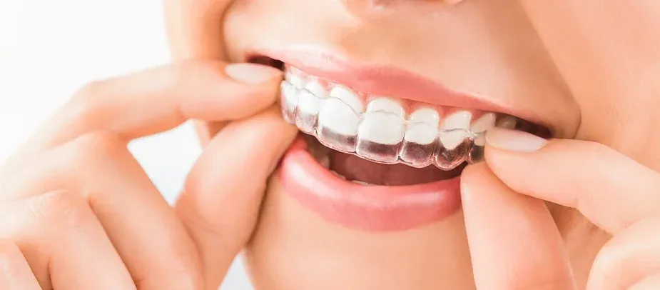 How to Make Your Invisalign Treatment Easier