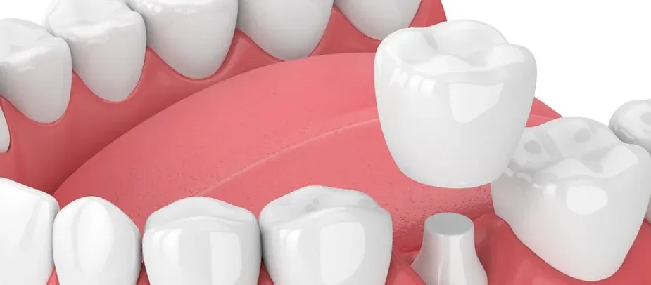 Why Are Dental Crowns The Right Choice For You?