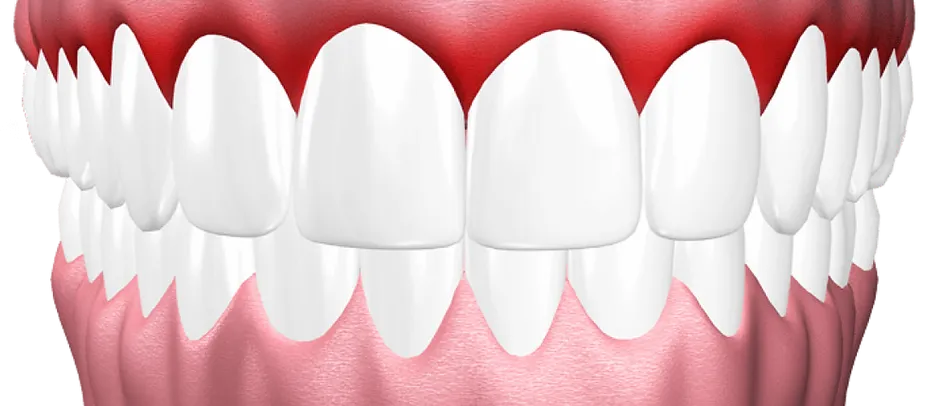 Want Full Arch Dental Implants Fast? Get Teeth In a Day