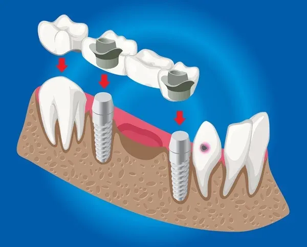 Dental Implants: What You Should Know? 