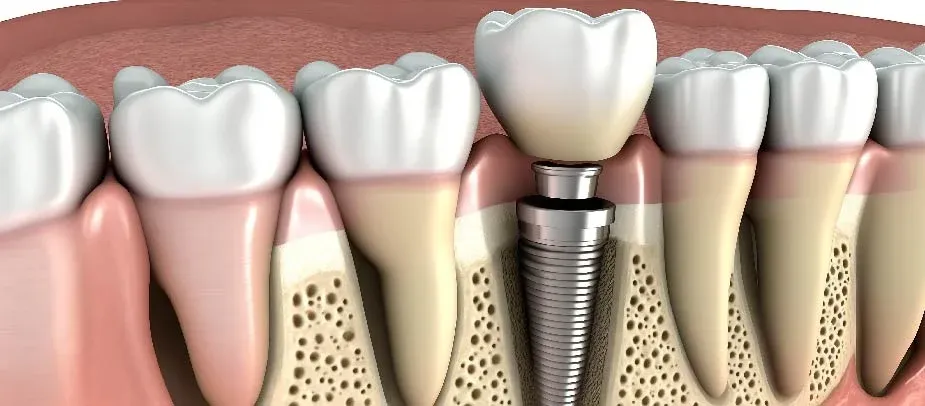 Dental Implants: What You Should Know? 