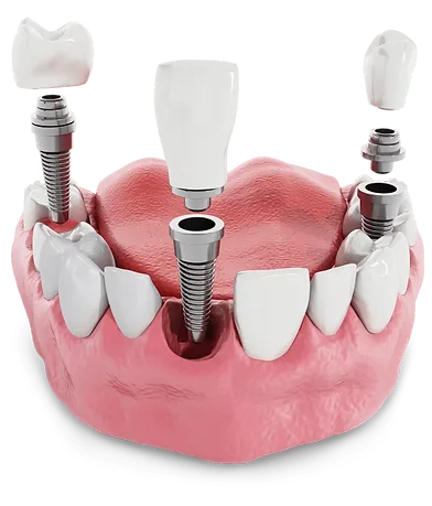 Benefits Of Dental Implants