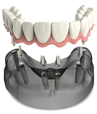 Benefits Of Dental Implants