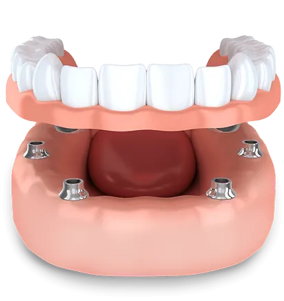 Benefits Of Dental Implants