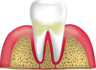 Gingivitis