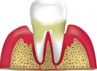 Periodontitis