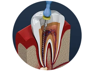 Infected tissue is removed and canals are cleaned.