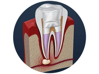 Infected Tooth